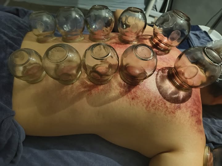 拔火罐的功效？拔罐后的五大注意事项