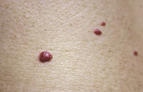 身上出现小红点是什么？樱桃状血管瘤、紫癜、还是蜘蛛痣