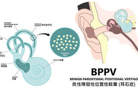 耳石症眩晕怎么办最快最有效，附具体操作及应急措施