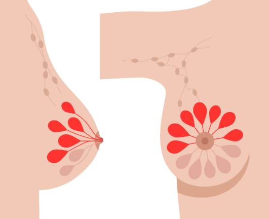 乳腺增生的症状有哪些？科学调理方法与日常护理全解析