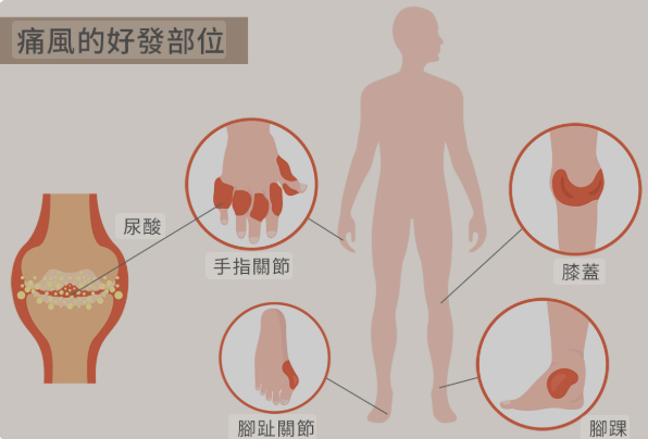 痛风加重的六个报警信号，痛风症状怎么缓解？权威科普详解