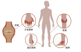 痛风和假性痛风有什么区别？症状、原因及治疗全解析