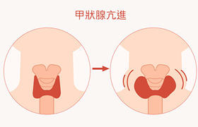 甲亢病是什么原因引起的,能治好吗？