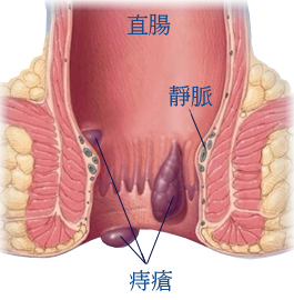 痔疮肉球突出怎么消除？