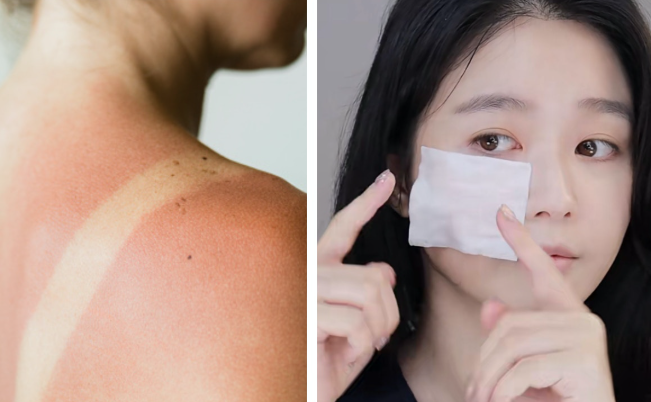 晒伤后抹什么药膏？5种晒伤修复药膏推荐与护理方法