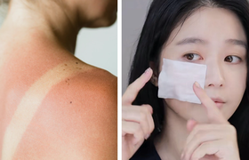 晒伤后涂什么药膏？5种晒伤修复药膏推荐与护理方法