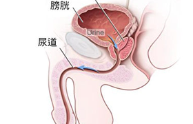 前列腺结石吃什么药好？