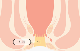 肛门消肿的最快方法？