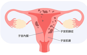子宫异常出血会自愈吗？