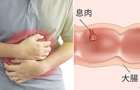 肠道息肉有什么症状？5大信号早发现，远离肠癌风险