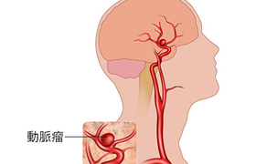 脑溢血的早期症状和原因，附预防方法