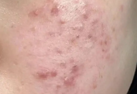 痤疮反复的原因？痤疮的根治性治疗