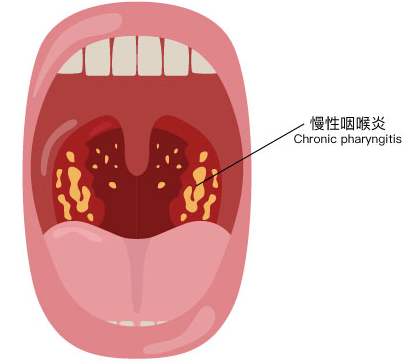 咽炎吃什么药好？盘点药店常用的10种止痛润喉药