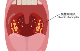 咽炎吃什么药好？盘点药店常用的10种止痛润喉药
