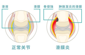 治疗滑膜炎医院排名推荐