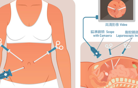 输卵管腹腔镜手术详细过程