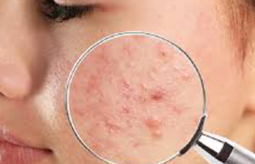 治疗痤疮的比较好医院