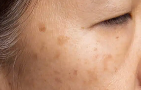 黄褐斑可以做激光吗