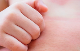 婴儿蛋清过敏症状