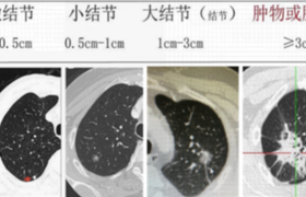 肺部有结节是怎么回事?要紧吗?