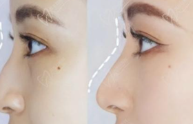 玻尿酸注射隆鼻好不好