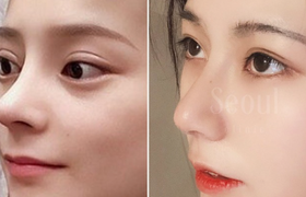 假体鼻子取出的方法