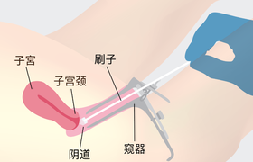 宫颈癌怎么筛查