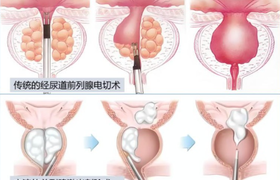 前列腺手术有哪些后遗症