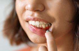 牙龈炎吃什么药治疗好