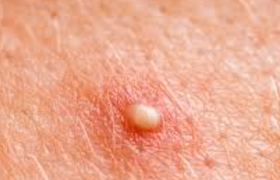 外阴痒有小疙瘩是什么病