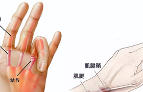 腱鞘炎是怎么引起的