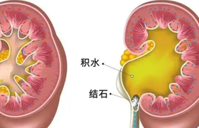肾积水的症状