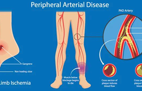 动脉硬化闭塞症治疗方法