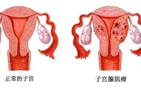 腺肌症是什么病