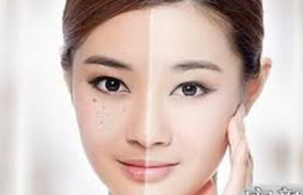 彩光祛斑和激光祛斑