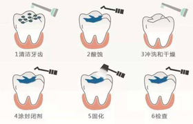 牙齿窝沟封闭是什么