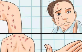 艾滋病患者低烧是多少度算低烧