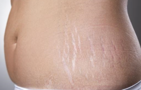 肥胖纹怎么去掉