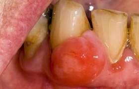 牙龈炎吃什么药