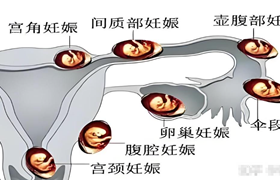 宫外孕是什么意思