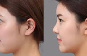 垫鼻梁有什么后遗症