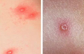 常见皮疹的种类