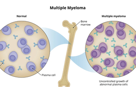 多发性骨髓瘤的症状有哪些