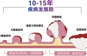 早期肠癌怎么自检