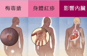 梅毒如何引起的