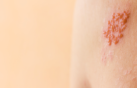 生殖器疱疹会自愈吗