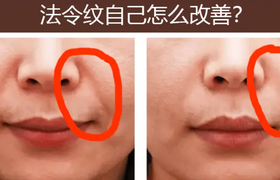 表情纹怎么去掉