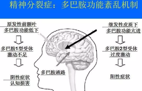 精分是什么原因引起的