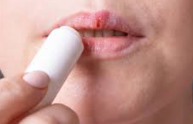 嘴唇干痒怎么办