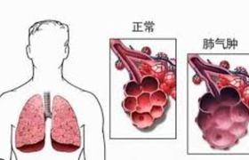 肺气肿是什么病